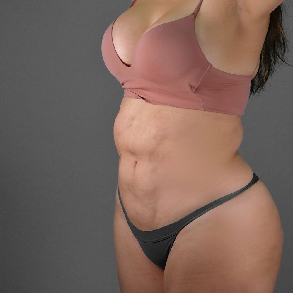 Resultado real de lipoescultura — paciente de Kento Cirugía y Nutrición en Quito