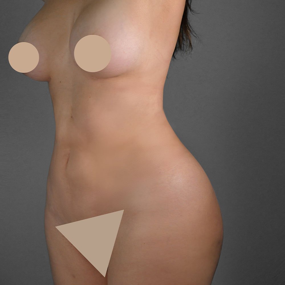 Resultado real de lipoescultura de contorno corporal — Kento Cirugía y Nutrición