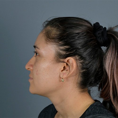 Antes de rinoplastia — caso real con giba nasal