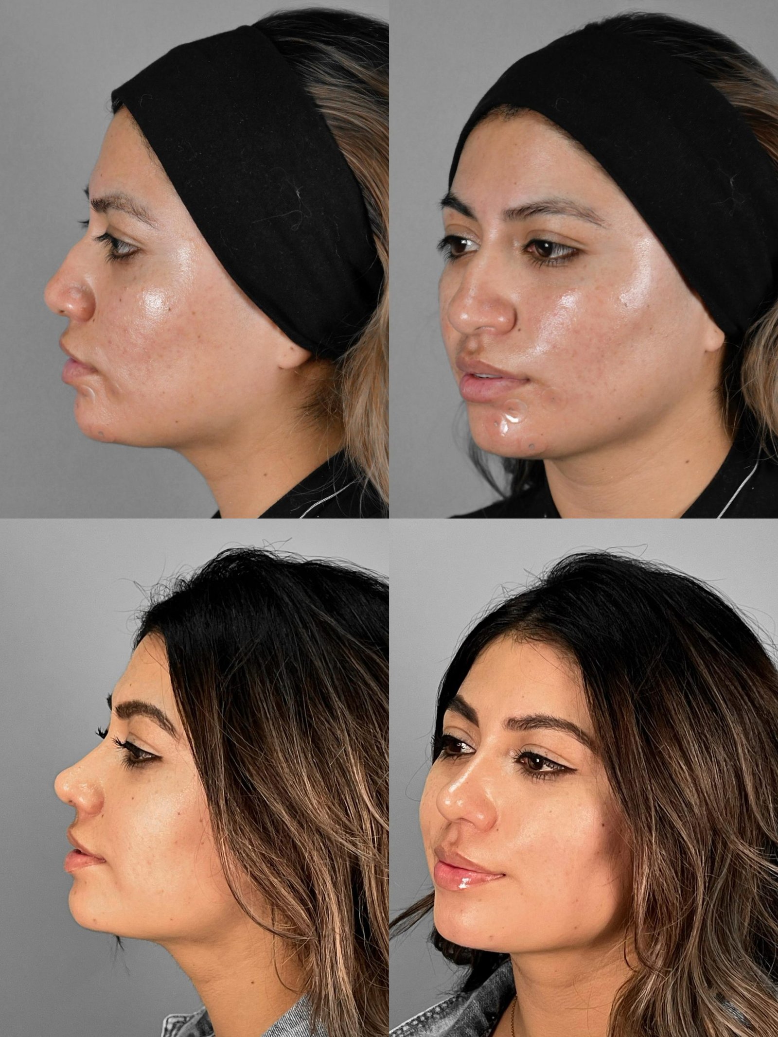 Rinoplastia en Quito — comparativa antes y después caso real