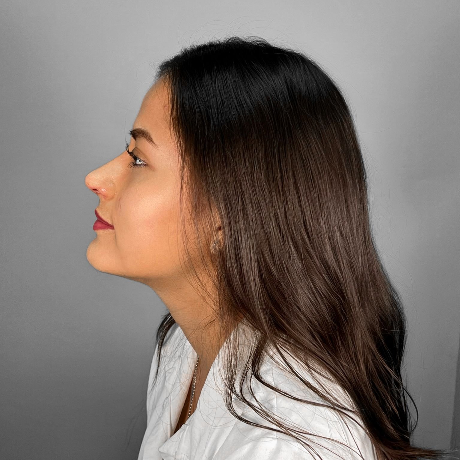 Después de rinoplastia — resultado natural caso real